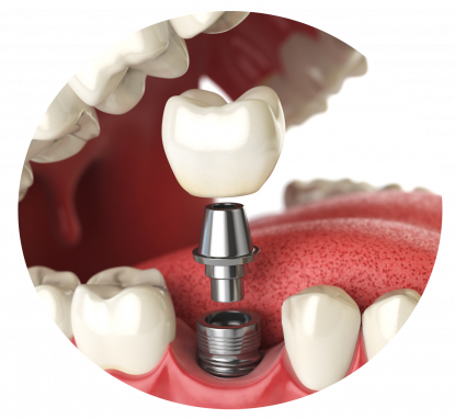 dental implant